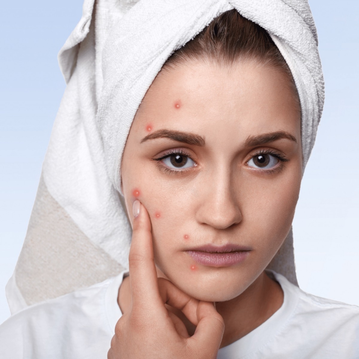 Woman with active acne and scarring touching cheek