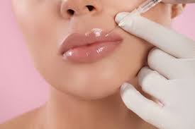 Dermal filler injection enhancing lip volume