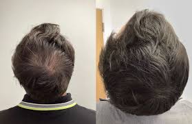 Platelet-rich plasma injections being given to scalp
