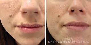 Close-up of mole removal with precision laser