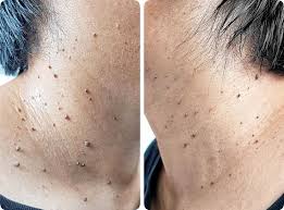Dermatologist using laser to remove skin tag