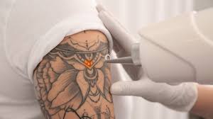 Technician removing tattoo with laser device