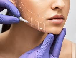PDO thread lift procedure lifting cheek