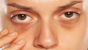 Close-up of woman's under-eye area for dark circle treatment