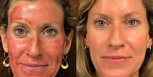 Clinician injecting platelet-rich plasma into patient's cheek